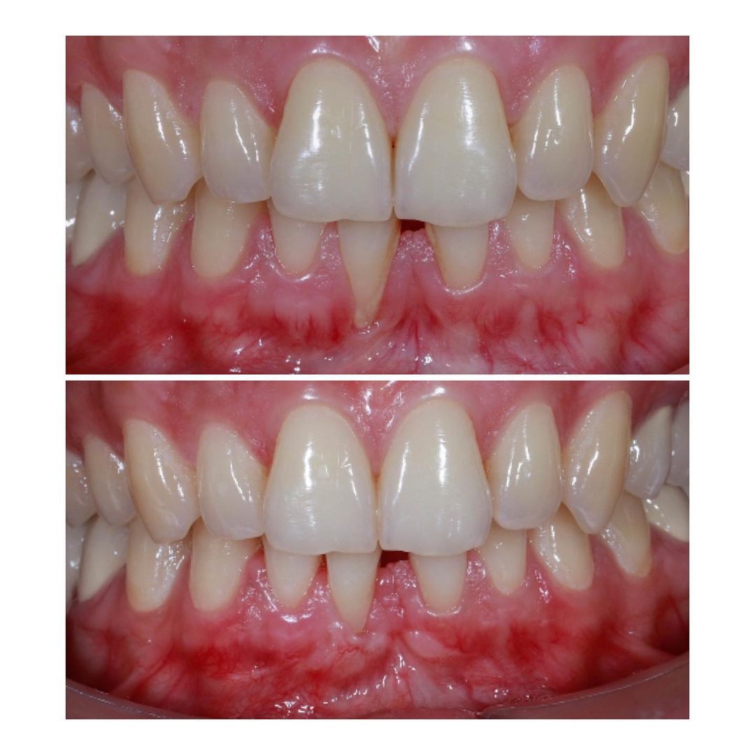 Alt kəsici dişətinin çəkilməsi olan pasientin damaqdan diş əti parçası alaraq bərpası