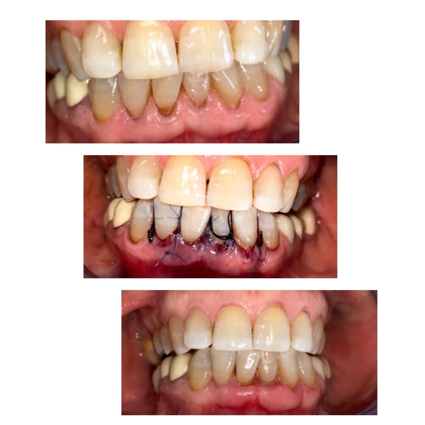 Diş əti çəkilməsi olan xəstənin tunel əməliyyatı ilə çəkilmənin qapadılması