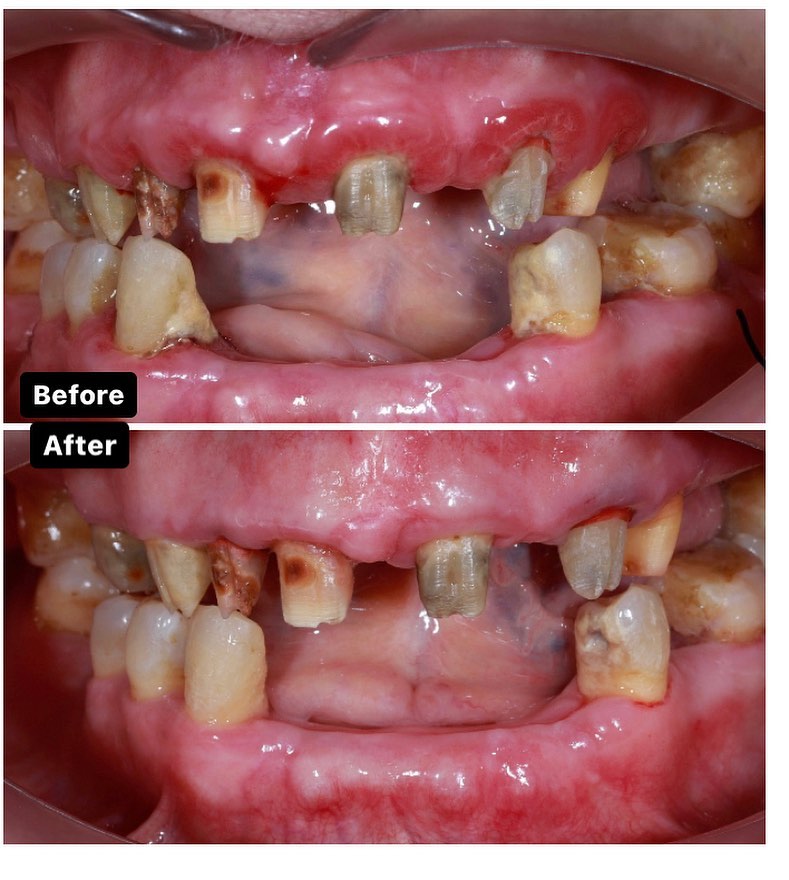 Diş ətində olan qızartı, şişkinlik və qanama kimi əlamətləri olan diş əti xəstəlikləri müalicə olunmalı və sonra qapaq ilə implant edilməlidi