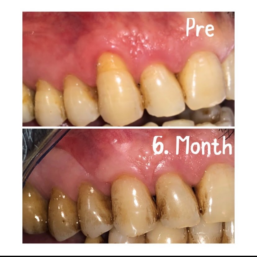 Dişətini koronelə çəkilməsi