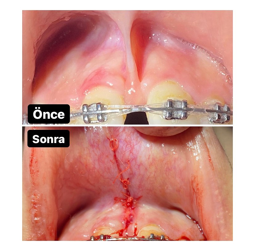 Dodaq Frenulum, orta mərkəz dişlərin aralanmasına səbəb olduğunda onu kəsmək göstərişdir
