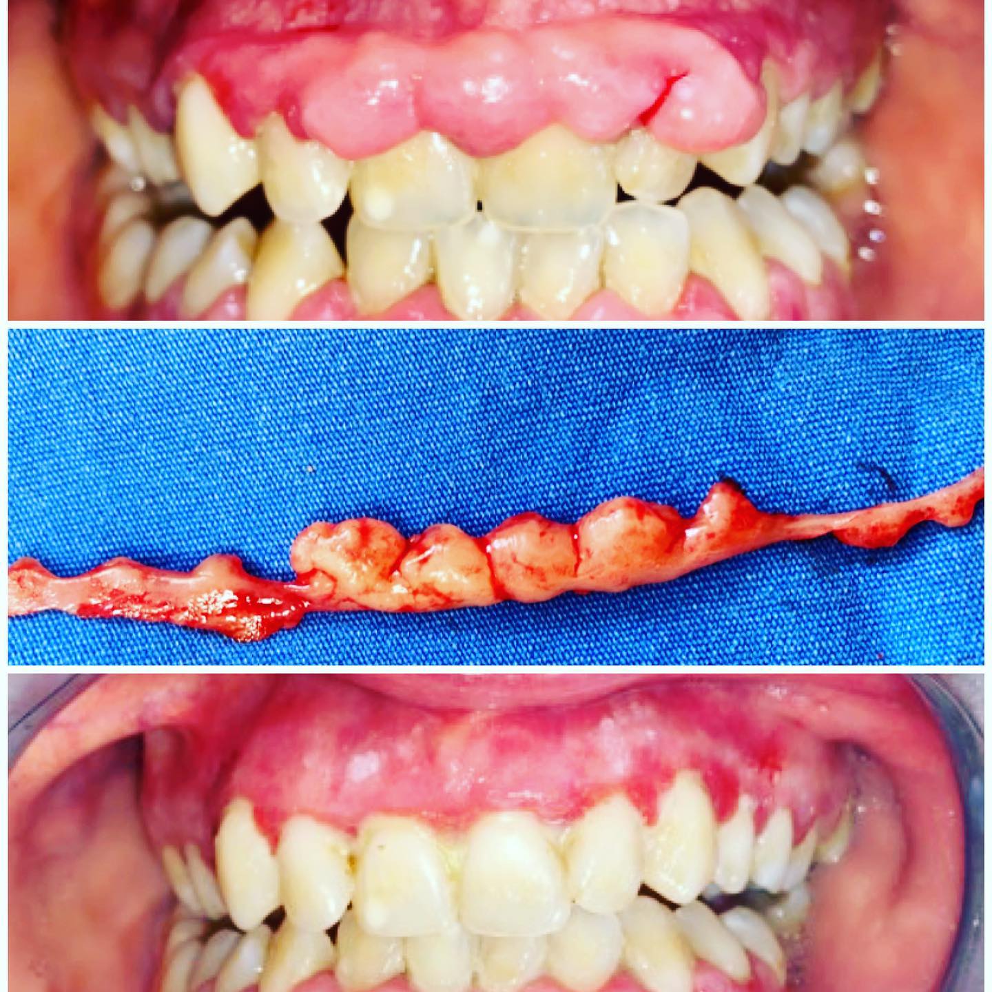 Gingivektomi (gigeniya əksikliyindən və ya bəzi dərmanların istifadəsindən meydana gələn aşırı diş əti böyüməsinin çıxarılması)