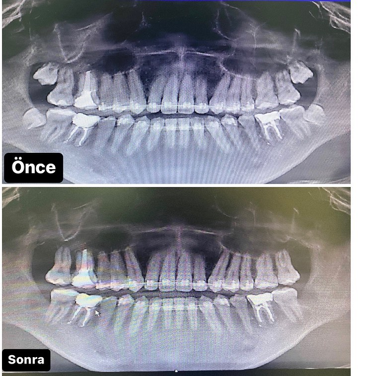 Gömülü ağıl dişlərinin çəkimi