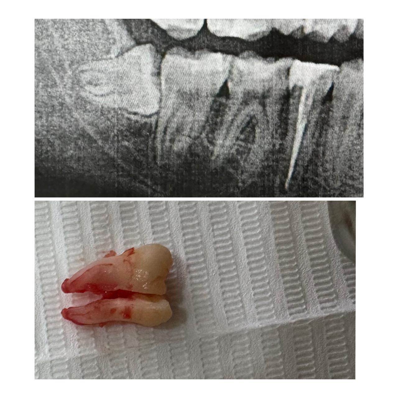 Gömülü dişin çəkimi