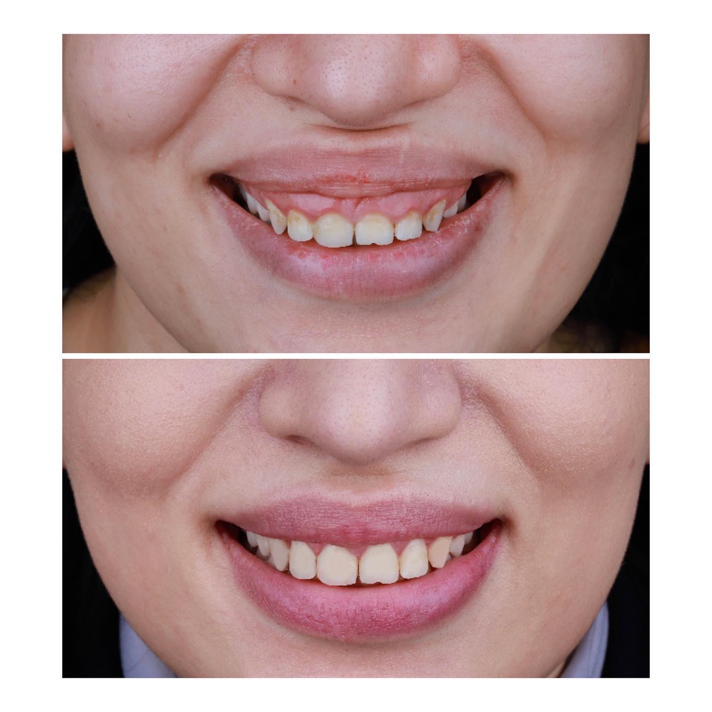 “Gummy smile” aradan qaldırılması