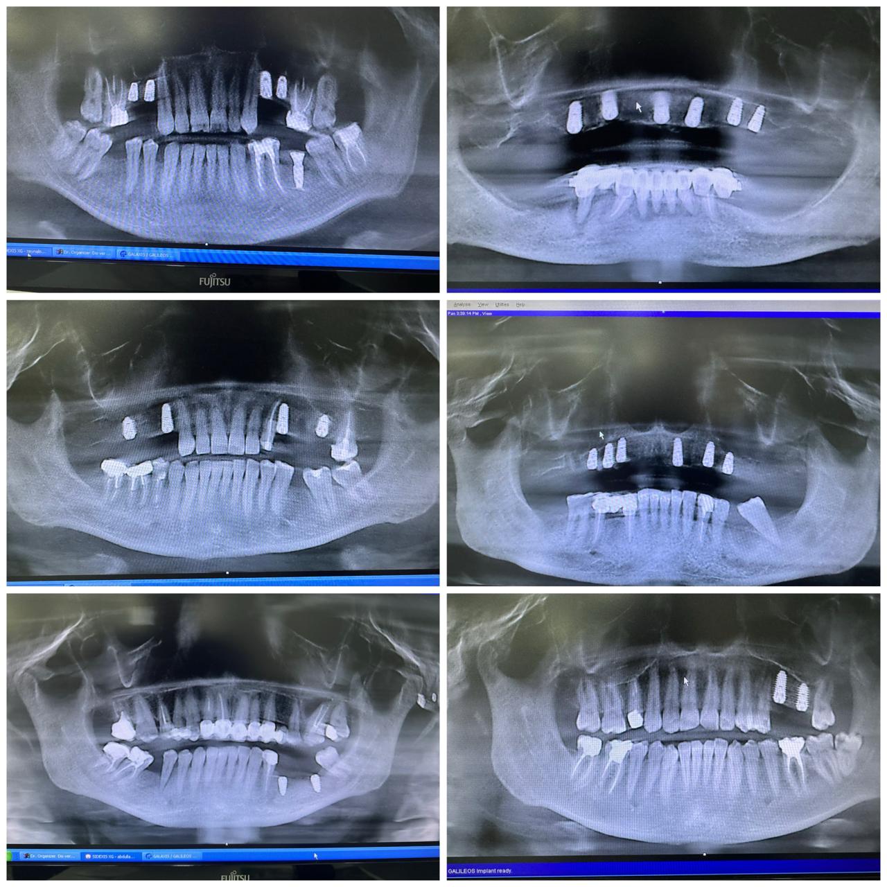 İmplant rentgenləri