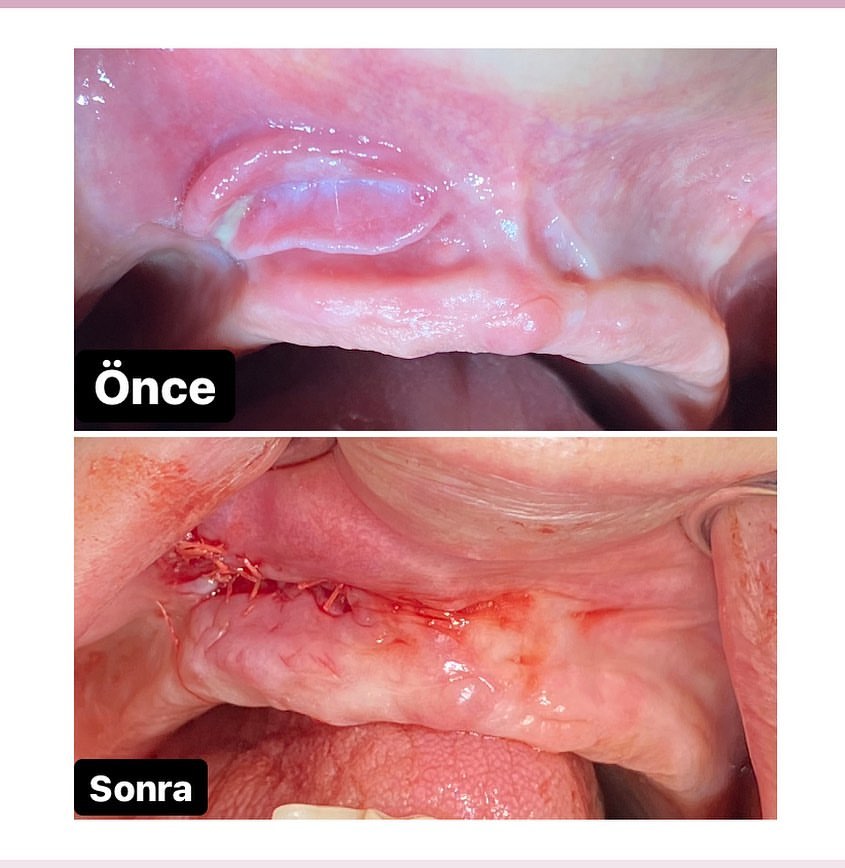 Protez kenaranın vuruğu zamanı meydana gələn “epulis fissuratum”