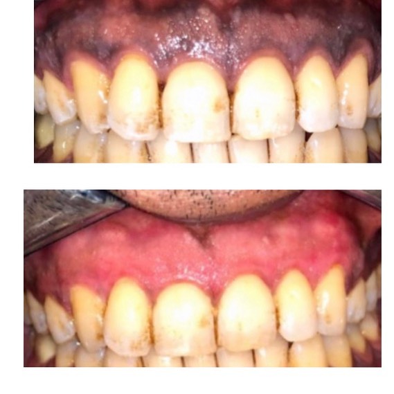 Siqaret və ya digər səbəblərdən yaranan rənglənmələrin götürülməsi