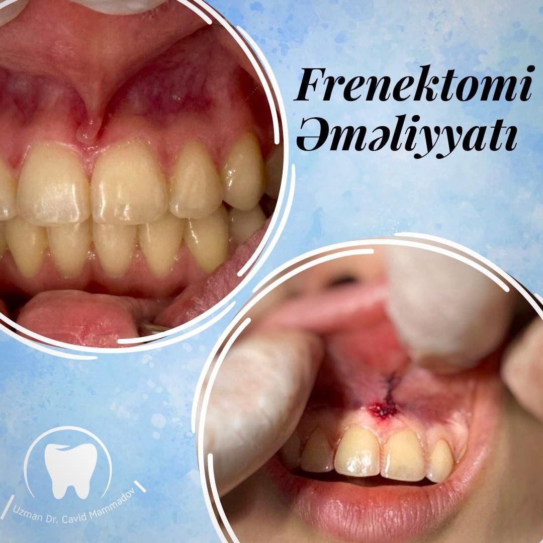 Uğurla icra edilən frenektomi əməliyyatı