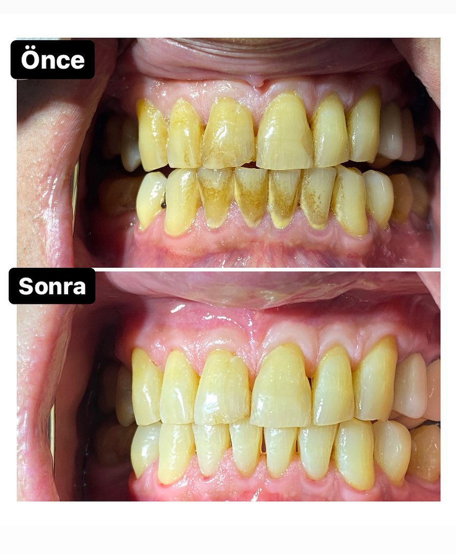 diş daşlarının təmizlənməsi