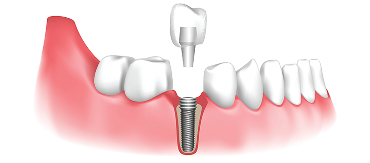 dental-implant-1