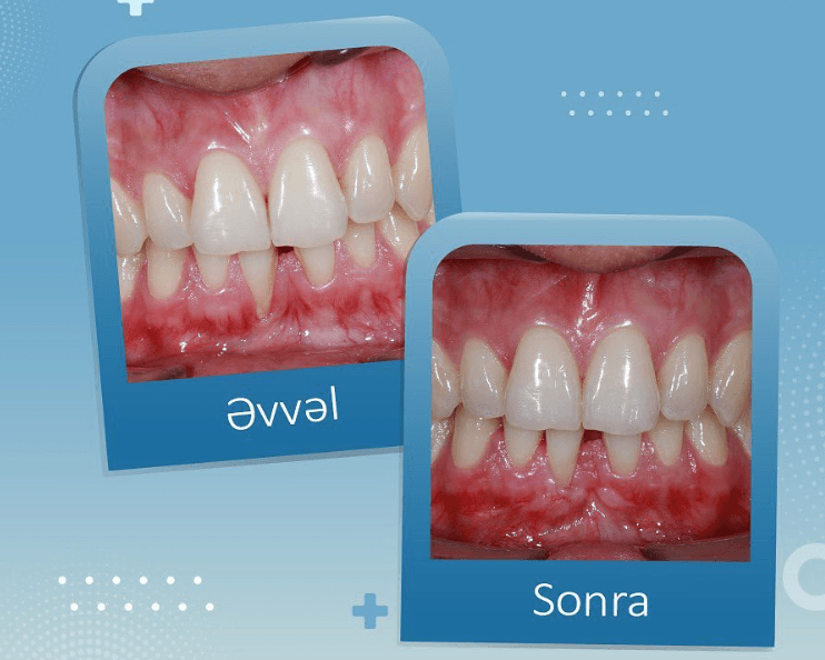 toxumalarain-transplantasiyasi